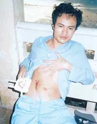 Phải mổ 6 lần… vì miếng gạc bỏ quên?!